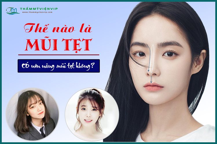 Thế nào là mũi tẹt?