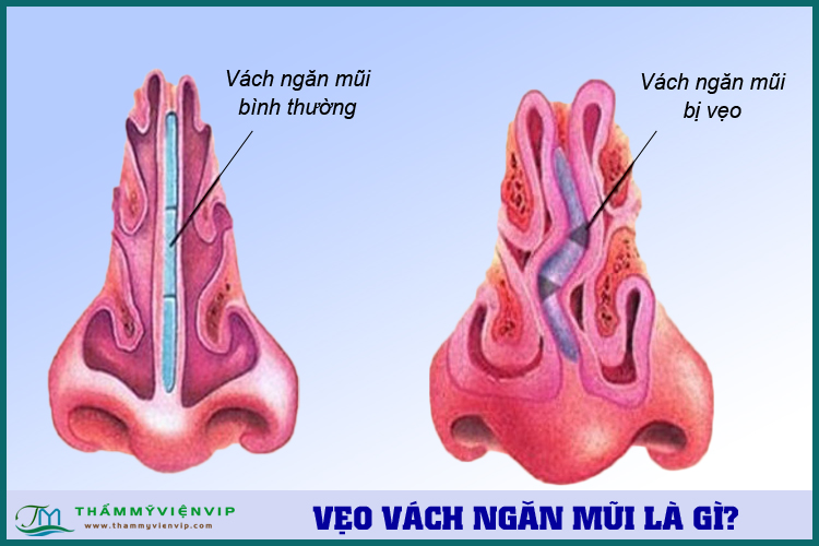 Vẹo vách ngăn ở mũi là gì? Các triệu chúng vẹo vách ngăn mũi